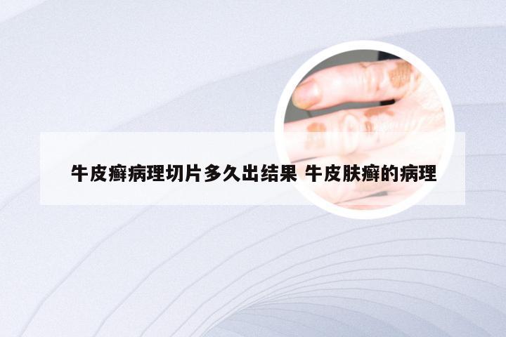 牛皮癣病理切片多久出结果 牛皮肤癣的病理
