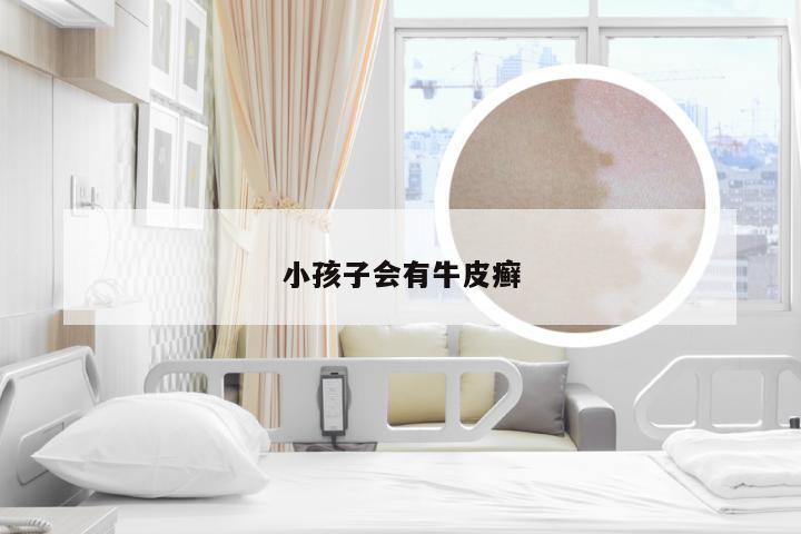 小孩子会有牛皮癣