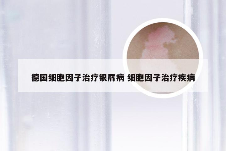 德国细胞因子治疗银屑病 细胞因子治疗疾病