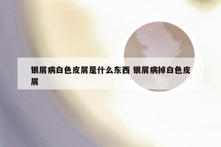 银屑病白色皮屑是什么东西 银屑病掉白色皮屑