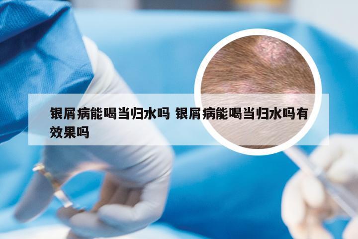 银屑病能喝当归水吗 银屑病能喝当归水吗有效果吗