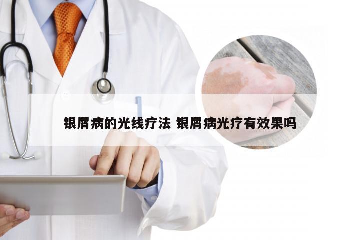 银屑病的光线疗法 银屑病光疗有效果吗