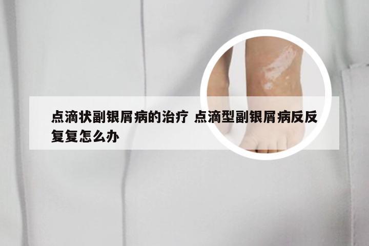 点滴状副银屑病的治疗 点滴型副银屑病反反复复怎么办