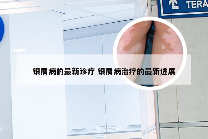 银屑病的最新诊疗 银屑病治疗的最新进展