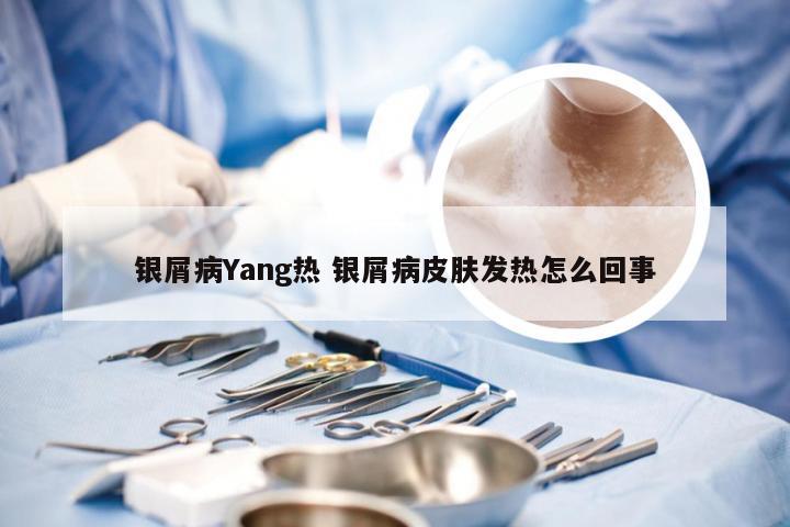 银屑病Yang热 银屑病皮肤发热怎么回事