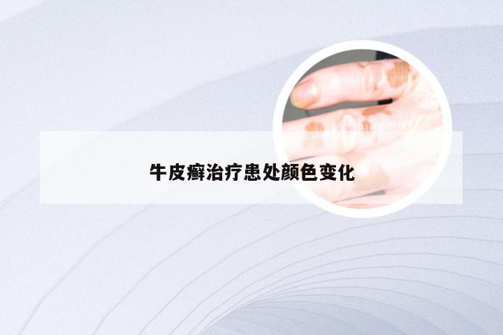 牛皮癣治疗患处颜色变化