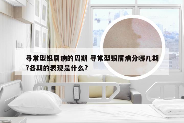 寻常型银屑病的周期 寻常型银屑病分哪几期?各期的表现是什么?