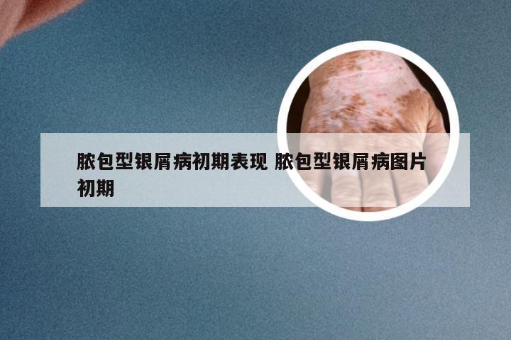 脓包型银屑病初期表现 脓包型银屑病图片 初期