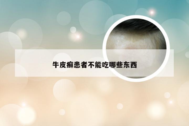 牛皮癣患者不能吃哪些东西