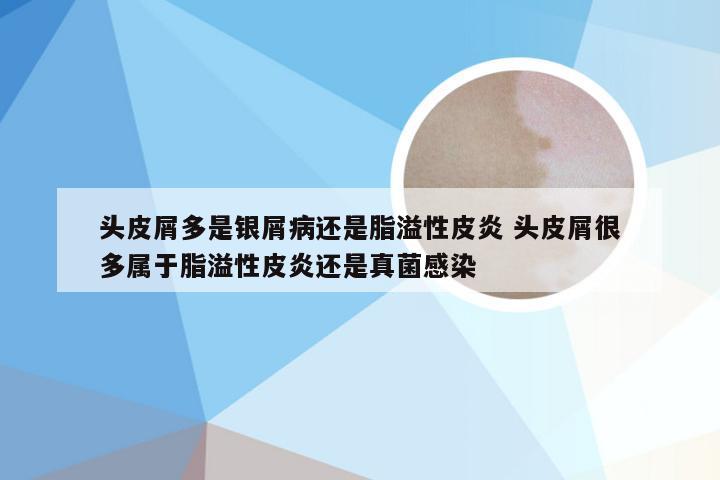 头皮屑多是银屑病还是脂溢性皮炎 头皮屑很多属于脂溢性皮炎还是真菌感染