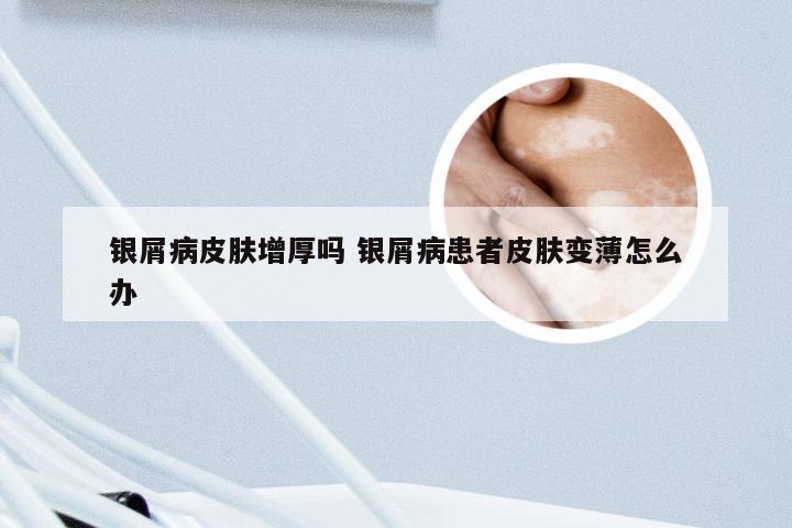 银屑病皮肤增厚吗 银屑病患者皮肤变薄怎么办