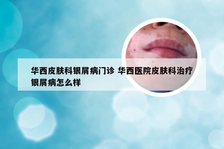 华西皮肤科银屑病门诊 华西医院皮肤科治疗银屑病怎么样
