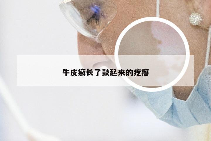 牛皮癣长了鼓起来的疙瘩