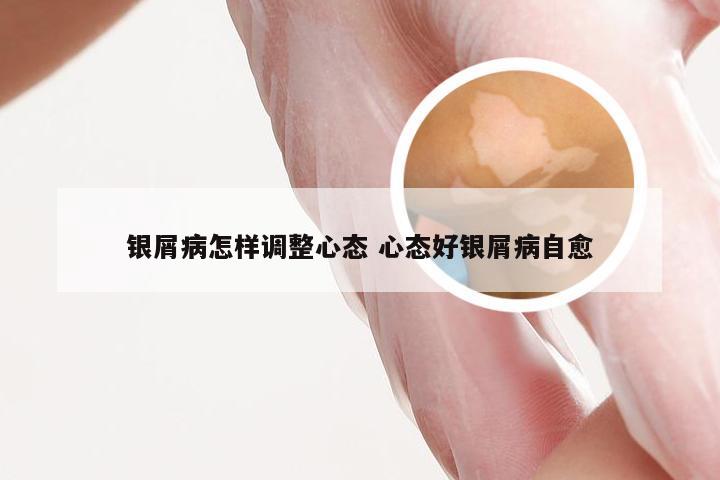 银屑病怎样调整心态 心态好银屑病自愈