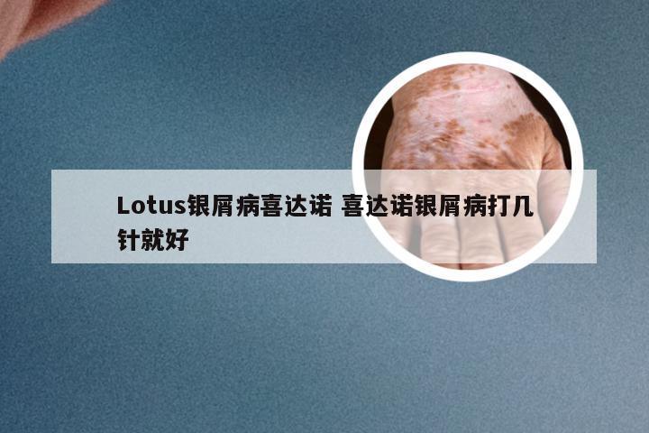 Lotus银屑病喜达诺 喜达诺银屑病打几针就好