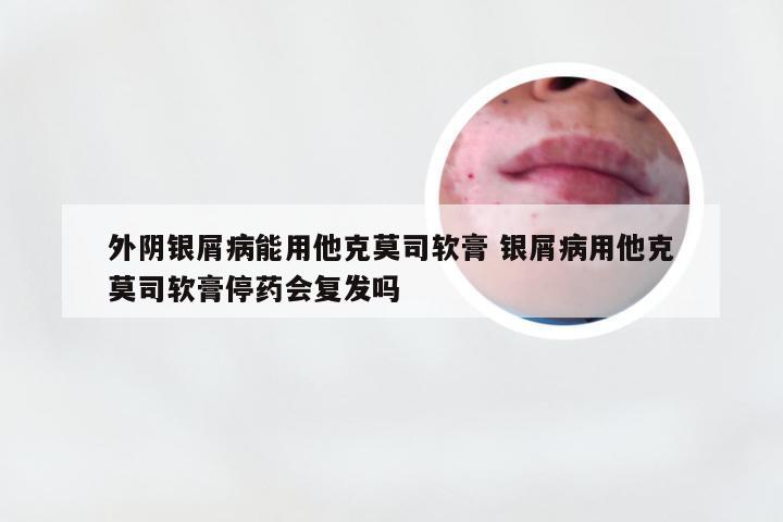 外阴银屑病能用他克莫司软膏 银屑病用他克莫司软膏停药会复发吗