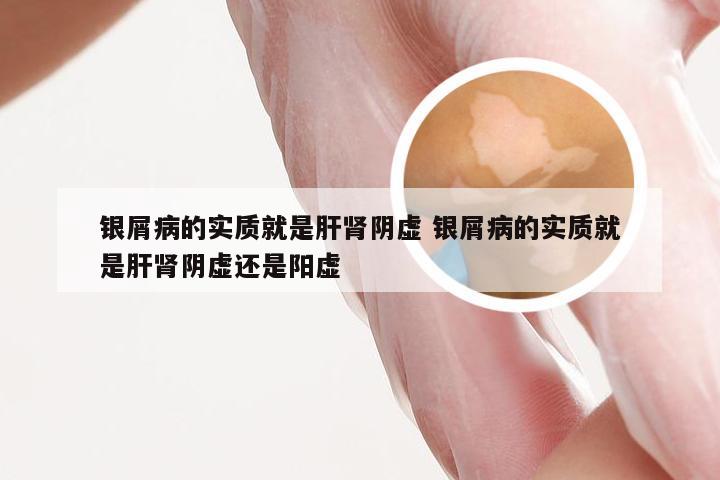 银屑病的实质就是肝肾阴虚 银屑病的实质就是肝肾阴虚还是阳虚