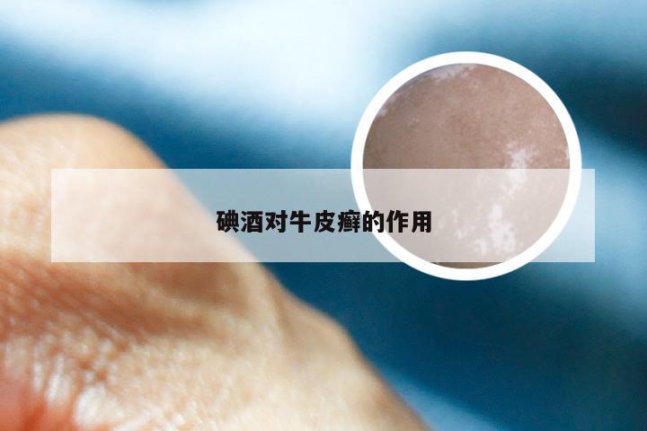 碘酒对牛皮癣的作用