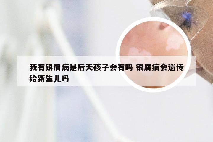 我有银屑病是后天孩子会有吗 银屑病会遗传给新生儿吗