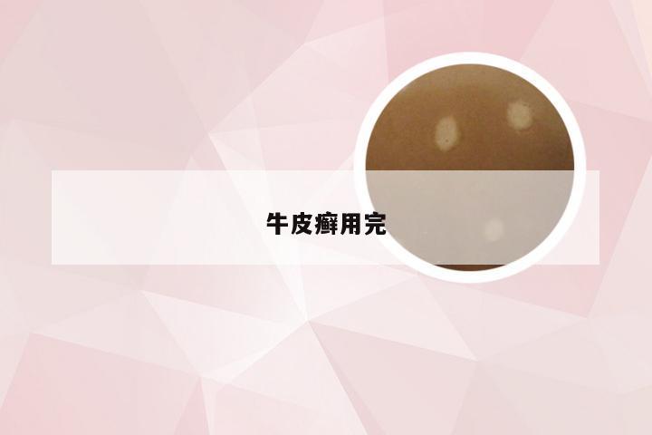牛皮癣用完