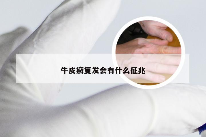 牛皮癣复发会有什么征兆