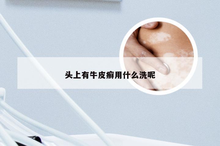 头上有牛皮癣用什么洗呢