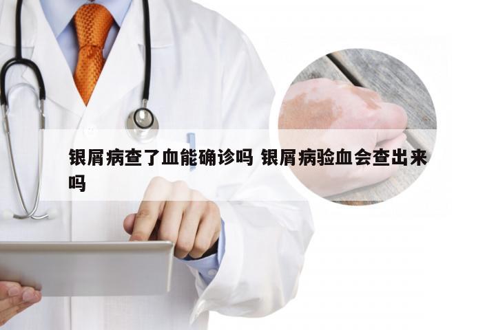 银屑病查了血能确诊吗 银屑病验血会查出来吗