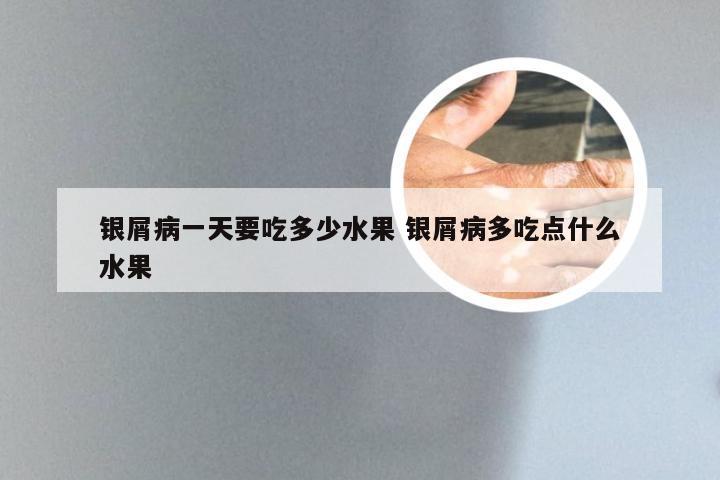 银屑病一天要吃多少水果 银屑病多吃点什么水果