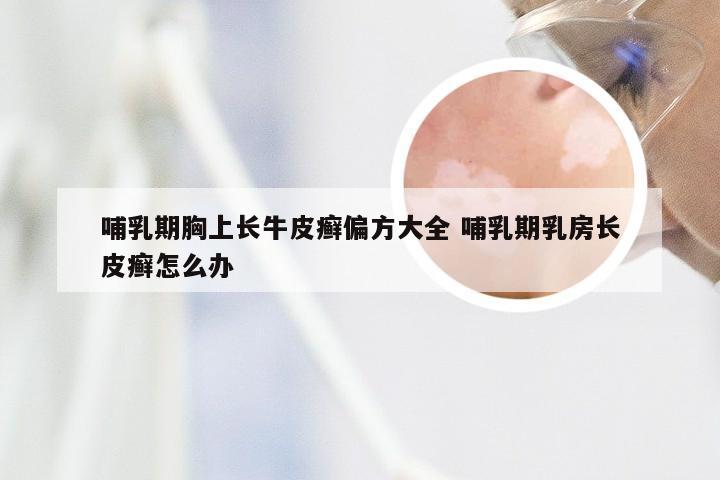 哺乳期胸上长牛皮癣偏方大全 哺乳期乳房长皮癣怎么办
