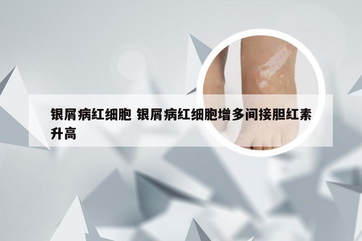 银屑病红细胞 银屑病红细胞增多间接胆红素升高