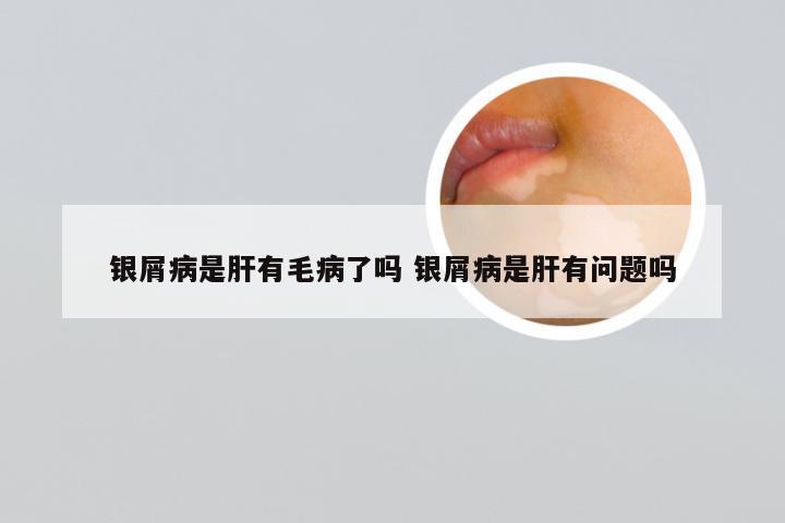 银屑病是肝有毛病了吗 银屑病是肝有问题吗
