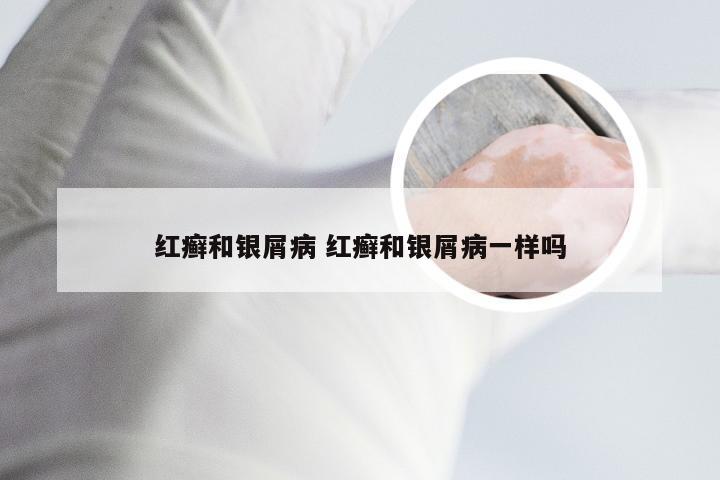 红癣和银屑病 红癣和银屑病一样吗