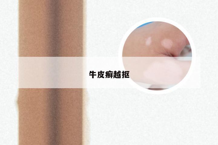 牛皮癣越抠
