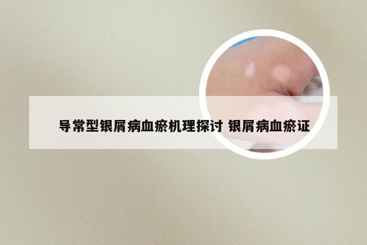 导常型银屑病血瘀机理探讨 银屑病血瘀证