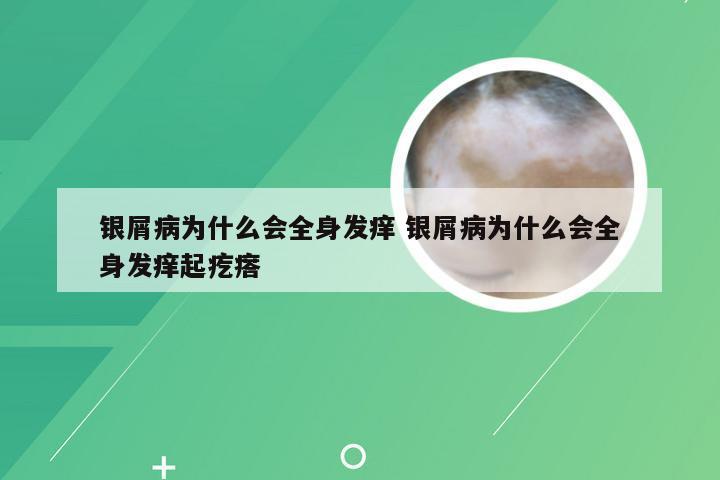 银屑病为什么会全身发痒 银屑病为什么会全身发痒起疙瘩
