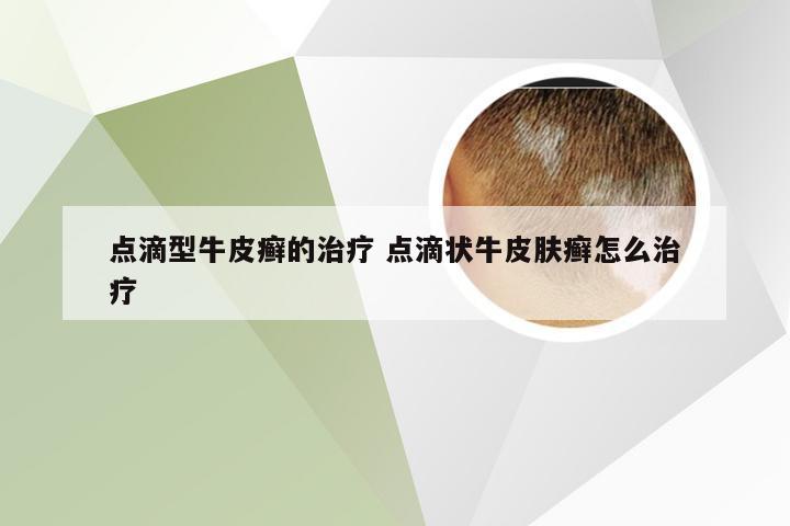 点滴型牛皮癣的治疗 点滴状牛皮肤癣怎么治疗