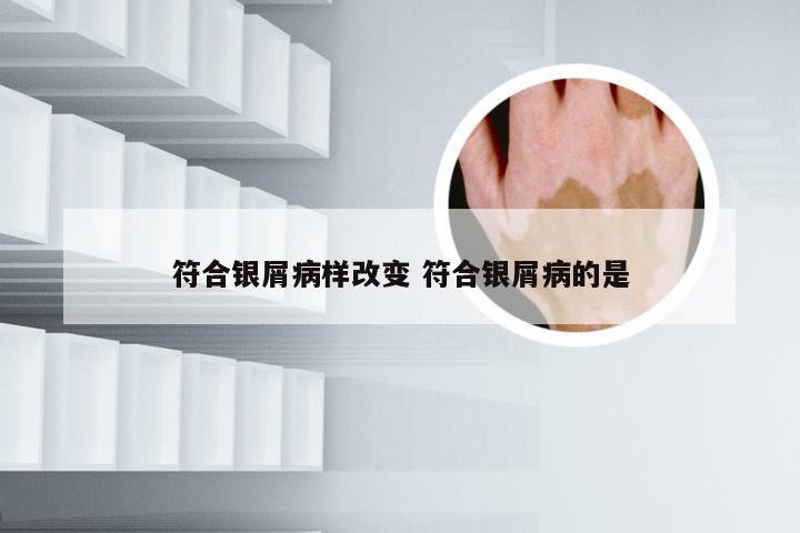 符合银屑病样改变 符合银屑病的是