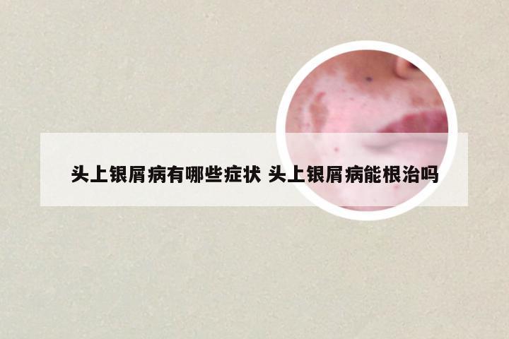 头上银屑病有哪些症状 头上银屑病能根治吗