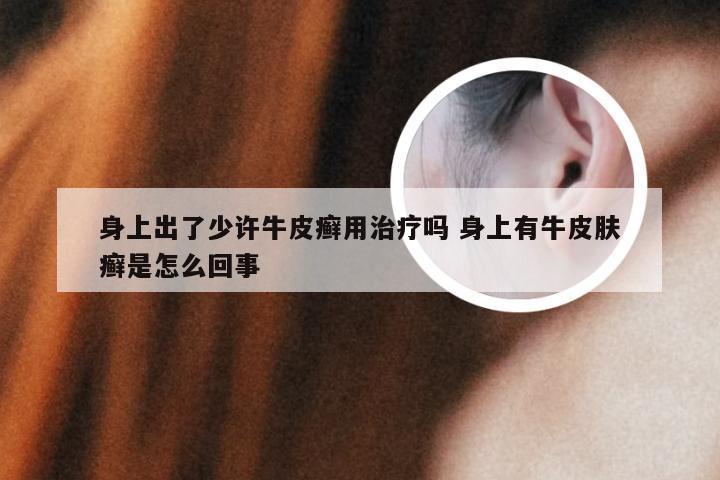 身上出了少许牛皮癣用治疗吗 身上有牛皮肤癣是怎么回事
