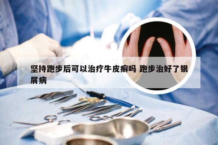 坚持跑步后可以治疗牛皮癣吗 跑步治好了银屑病