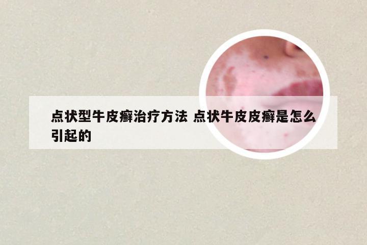 点状型牛皮癣治疗方法 点状牛皮皮癣是怎么引起的
