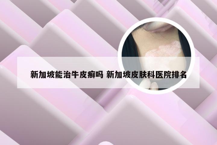 新加坡能治牛皮癣吗 新加坡皮肤科医院排名
