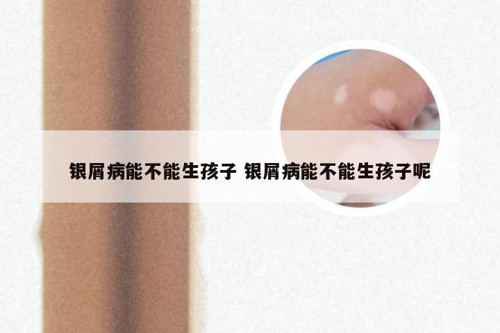 银屑病能不能生孩子 银屑病能不能生孩子呢