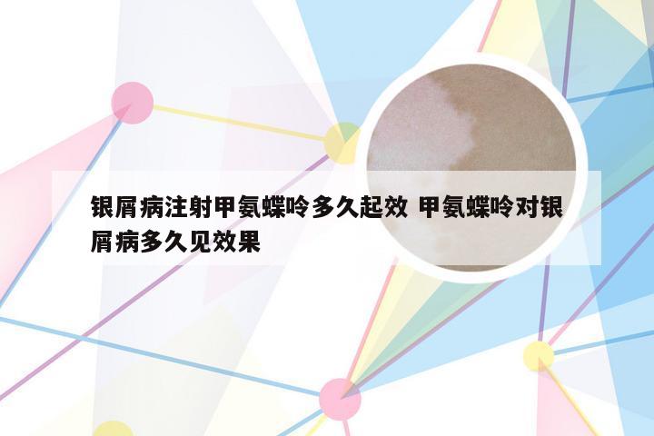 银屑病注射甲氨蝶呤多久起效 甲氨蝶呤对银屑病多久见效果
