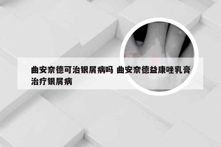 曲安奈德可治银屑病吗 曲安奈德益康唑乳膏治疗银屑病