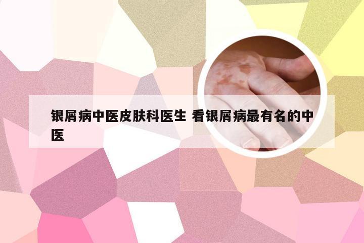 银屑病中医皮肤科医生 看银屑病最有名的中医