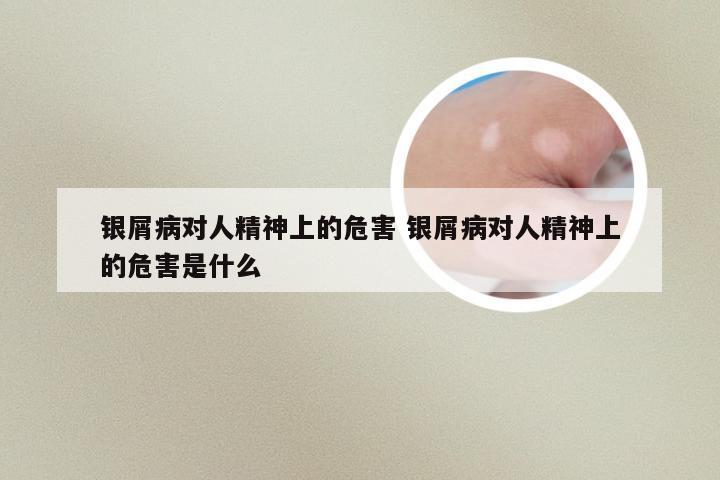 银屑病对人精神上的危害 银屑病对人精神上的危害是什么