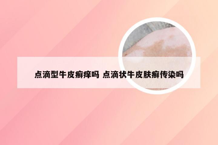点滴型牛皮癣痒吗 点滴状牛皮肤癣传染吗