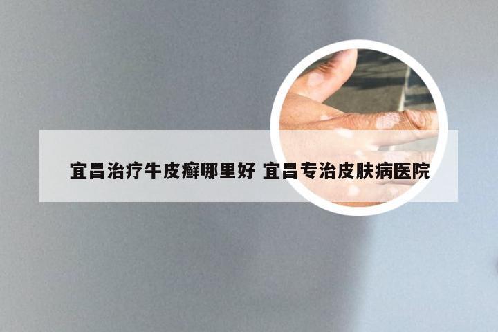宜昌治疗牛皮癣哪里好 宜昌专治皮肤病医院