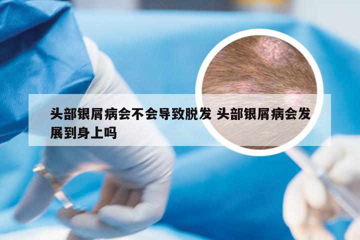 头部银屑病会不会导致脱发 头部银屑病会发展到身上吗